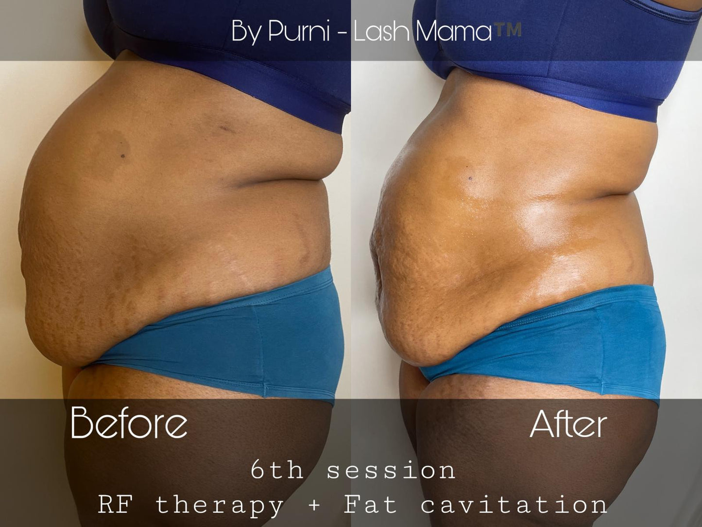 RF + Fat Cavitation + Lipo 6 In 1 Machine (Includes Shipping and 12 months warranty)