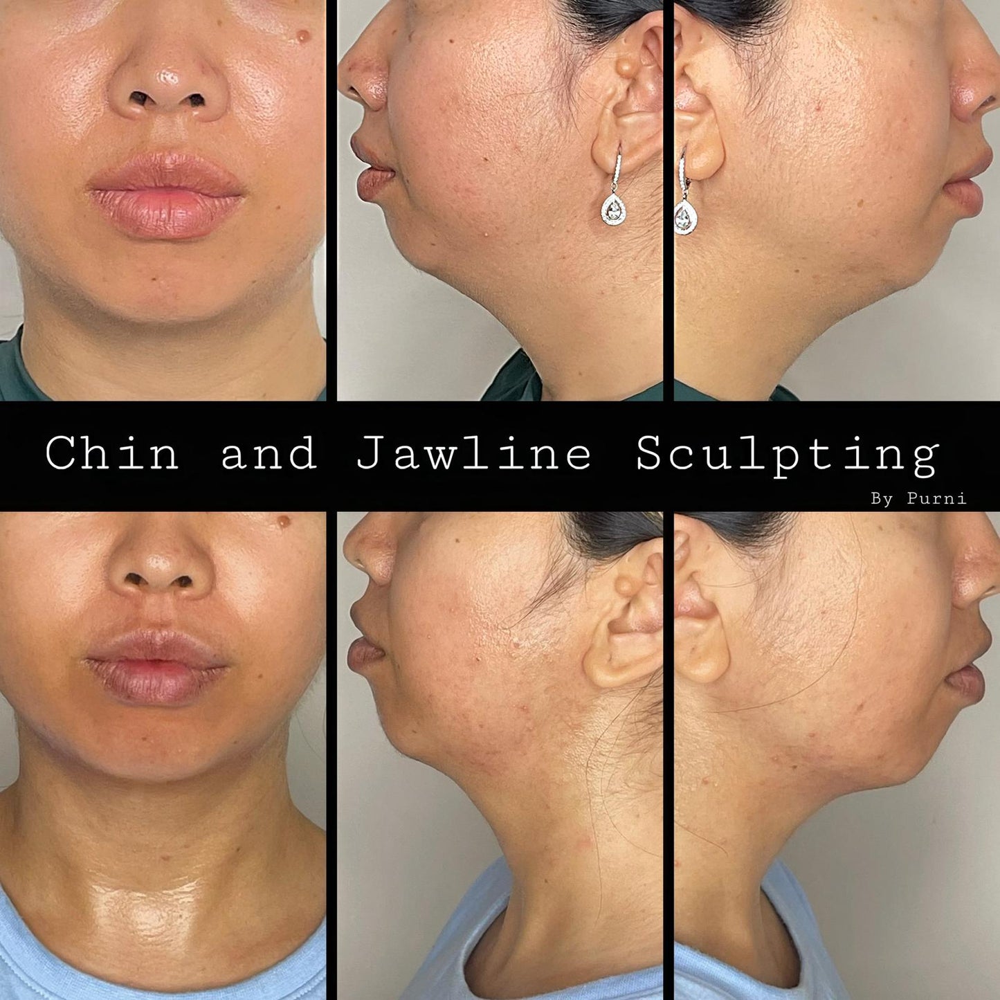 RF + Fat Cavitation + Lipo 6 In 1 Machine (Includes Shipping and 12 months warranty)